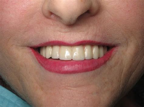 Fixed Dental Implant Bridge vs. Implant Denture - What is the REAL Difference? - Dental Implant ...