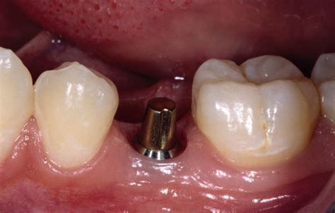 Dental Implant Abutment