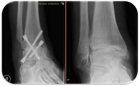 Ankle Fusion Dubai | Ankle Fusion Surgery in Dubai - Dr Ehab Kheir