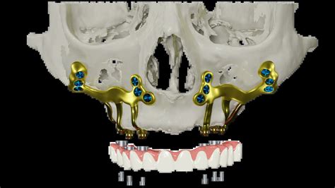 Custom-made subperiosteal dental implant