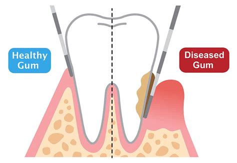 Periodontal Surgery/Pocket Depth Reduction | Periodontal Procedures