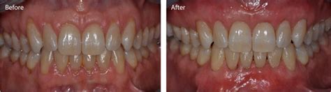 Noninvasive Pinhole Gum Recession Surgery Philadelphia