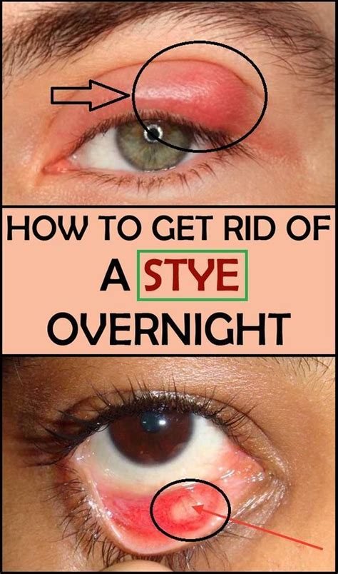 How To Get Rid Of a Stye Overnight | Get rid of stye