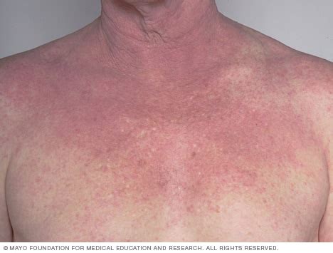 Atopic dermatitis (eczema) - Symptoms and causes - Mayo Clinic