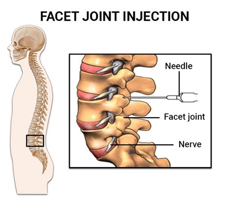 Facet Joint Injections | The Spine & Rehab Group
