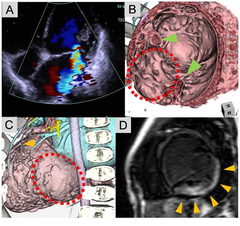 Figure 1 from Surgical repair of a posterior left ventricular aneurysm in a 4-year-old boy ...