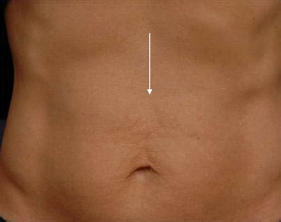 Abdominal Thermage Before and After Pictures | Santa Monica Laser and ...