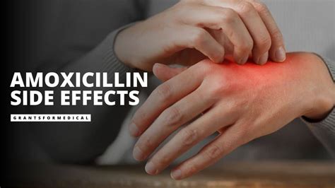 Amoxicillin Side Effects You Should Know About