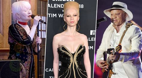 Lifestyle News | International Albinism Awareness Day 2020: Famous ...