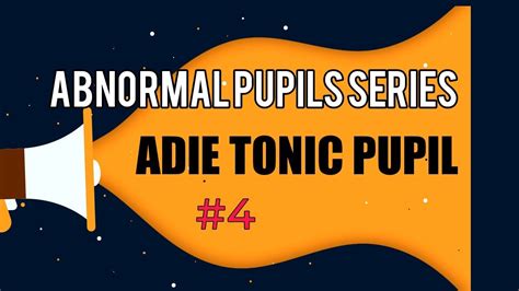 ADIE TONIC PUPIL || DIAGNOSIS AND TREATMENT OF ADIE TONIC PUPIL || Abnormal pupil series # 4 ...