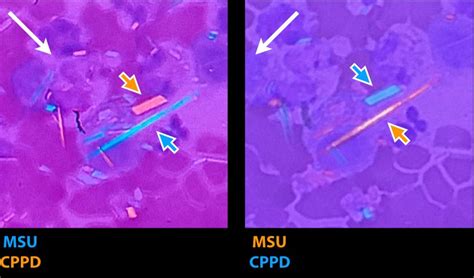 Gout Vs Pseudogout Crystals