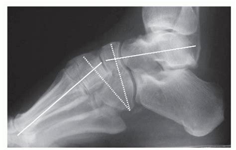 Pes Cavus Surgery | Musculoskeletal Key