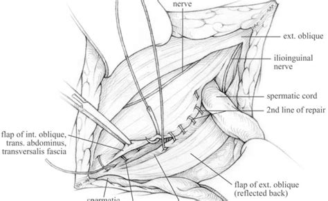 Shouldice Technique Inguinal Hernia Repair Broken Curve – Otosection