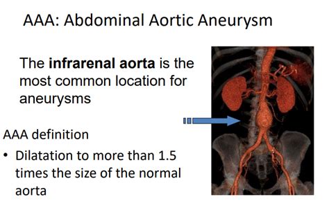 Abdominal Aortic Aneurysm Treatment & Medical Management - Dr. Hiranya ...