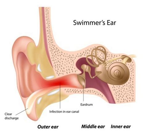 What is Otitis Externa (Swimmers Ear)? (Symptoms, Causes, and Treatment ...