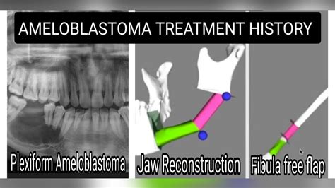 Plexiform ameloblastoma treatment history (Hindi)//Jaw reconstruction # ...