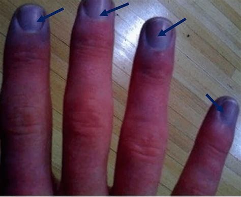 Cyanosis definition, causes, symptoms, diagnosis & treatment