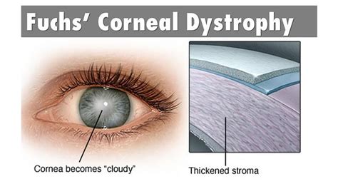 Femtosecond Laser-Assisted Cataract Surgery in Fuchs Endothelial Corneal Dystrophy: Long-term ...