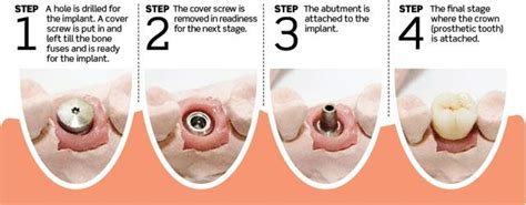 http://moderndentistrysilverspring.wordpress.com/2014/03/10/dental-implants-surgery-how-it-is ...