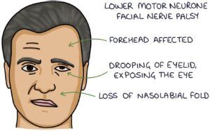 Facial Nerve Palsy – Zero To Finals