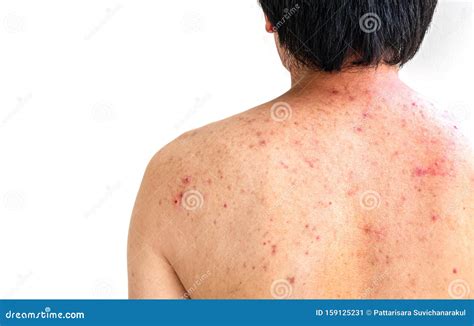 Men with Acne, with Red Spots on the Back Stock Image - Image of adolescence, back: 159125231