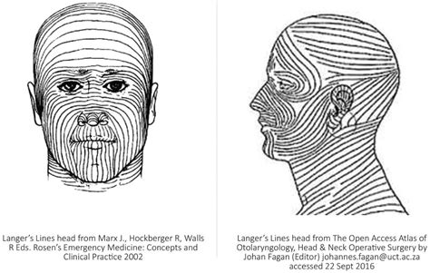 Biodynamic Excisional Skin Tension (BEST) Lines: Revisiting Langer’s ...