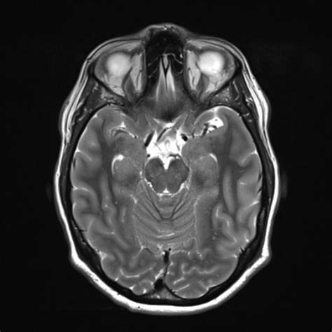 Normal brain MRI | Radiology Case | Radiopaedia.org | Mri, Brain scan ...