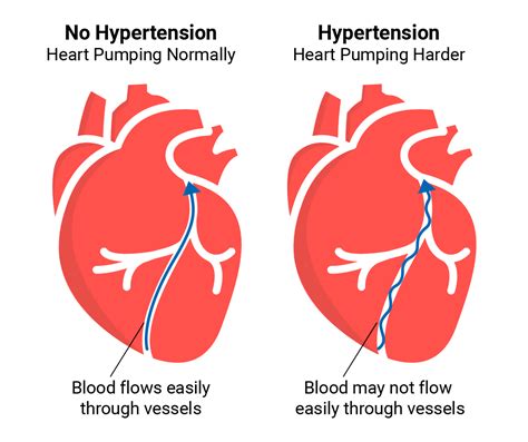 What is Hypertension And Normal Blood Pressure?