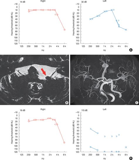 Figure 1 from Vestibulocochlear Symptoms Caused by Vertebrobasilar Dolichoectasia | Semantic Scholar