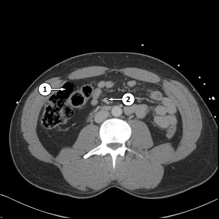 CT abdomen/pelvis (lower) axial - labelling questions | Radiology Case | Radiopaedia.org