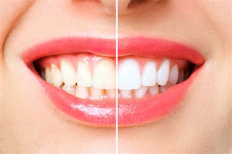 The Step By Step Guide to Professional Teeth Whitening