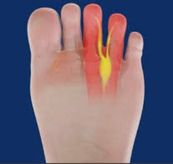 Neuroma - KARR FOOT & LEG CENTER