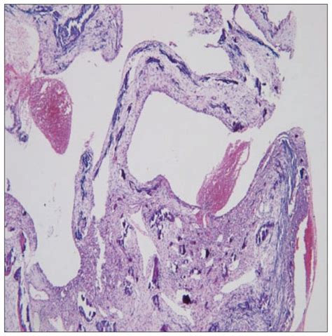 Histopathological examinatin shows hemorrhagic cystic spaces and... | Download Scientific Diagram