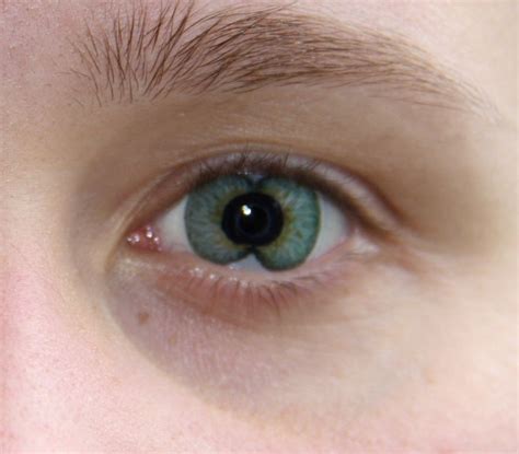 double pupil - Google Search | Medical, Abnormal, Pupil