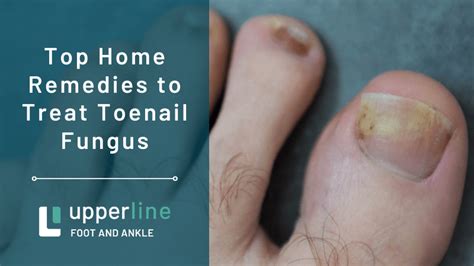 Top Home Remedies to Treat Toenail Fungus