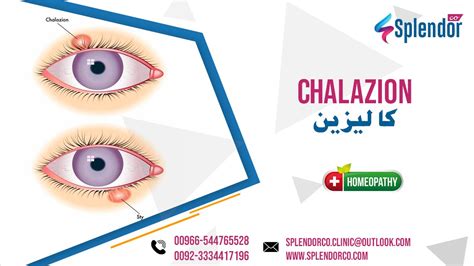 Homeopathic Medicines for Chalazion