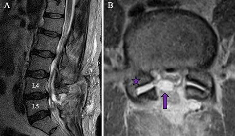 Acute development of spinal lumbar synovial facet cyst within 1 week after lumbar decompression ...