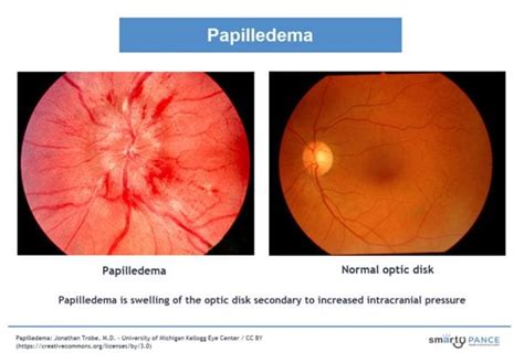 Papilledema (ReelDx) - Smarty PANCE