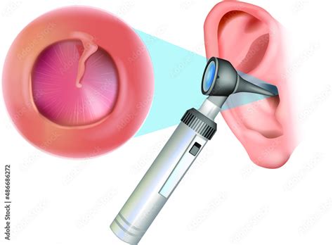 Stockvektorbilden Ear examination with an otoscope. Otitis media with effusion: serous otitis ...