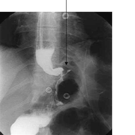 Vertical banded gastroplasty as described by MacLean et al. [13 ...