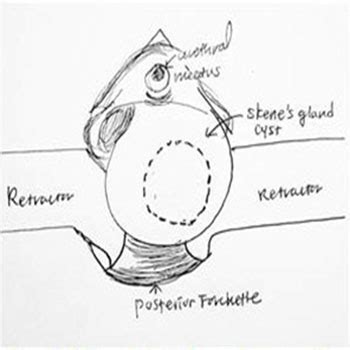 Marsupialization of Skene’s Gland Cyst