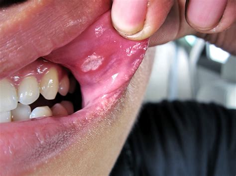 Mouth Ulcer HIV Treatment The Easy Way - Ending AIDS