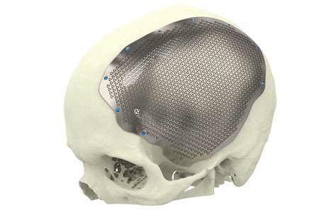 XSuture for soft tissue suspension | Xilloc