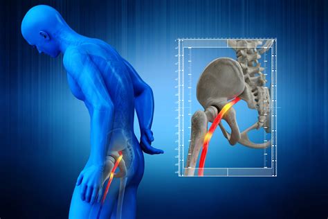 5 Methods for Sciatic Nerve Pain Relief