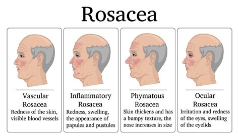 The Best Essential Oils And Essential Oil Recipes For Rosacea Skin ...