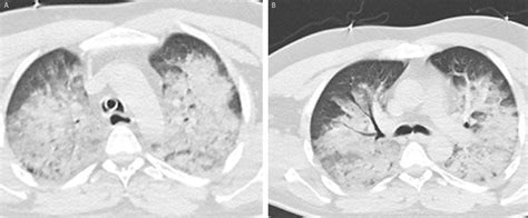 A case with neurogenic pulmonary edema