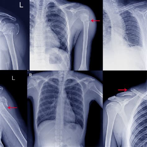 Shoulder Partial (Subluxation) or Full Dislocation Physiotheraphy