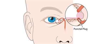 Punctal Plug as a treatment for dry eyes | Basir Eye Center