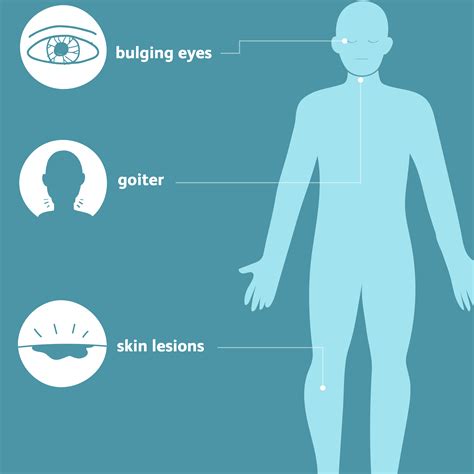 Graves' Disease: Symptoms, Causes, Diagnosis, Treatment