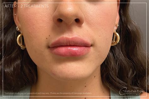 Before and After - Juvederm Ultra - Lips (20 yo) | Concierge Aesthetics